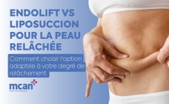 Endolift vs Liposuction for Loose Skin fr