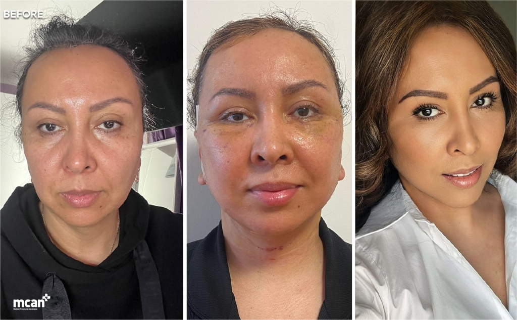 Injerto de grasa facial: cuánta grasa se extrae y de dónde 5 Fat Grafting and Facial Surgery in Turkey with MCAN Health 2 Fat Grafting and Facial Surgery in Turkey with MCAN Health 2