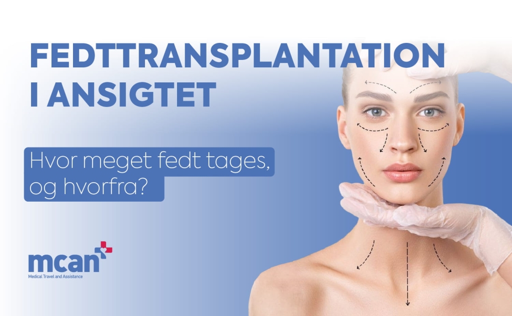 Fedttransplantation i ansigtet: hvor meget fedt tages, og hvorfra? 1 Fat Grafting in Facial Surgery da Fat Grafting in Facial Surgery da