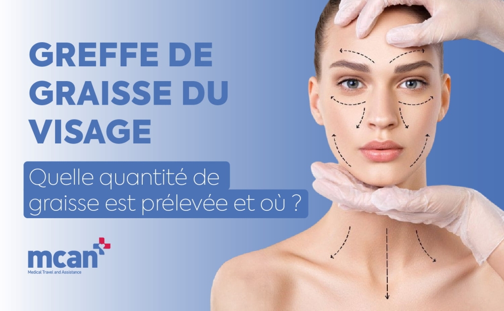 Greffe de graisse du visage : quelle quantité de graisse est prélevée et où ? 1 Fat Grafting in Facial Surgery fr Fat Grafting in Facial Surgery fr