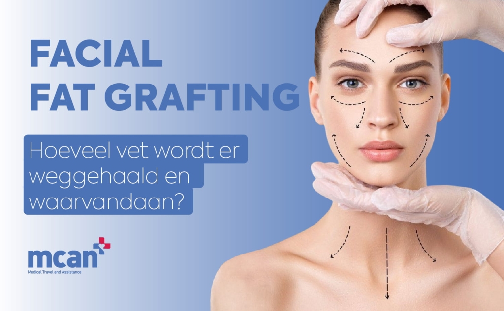 Facial fat grafting: hoeveel vet wordt er weggehaald en waarvandaan? 1 Fat Grafting in Facial Surgery nl Fat Grafting in Facial Surgery nl