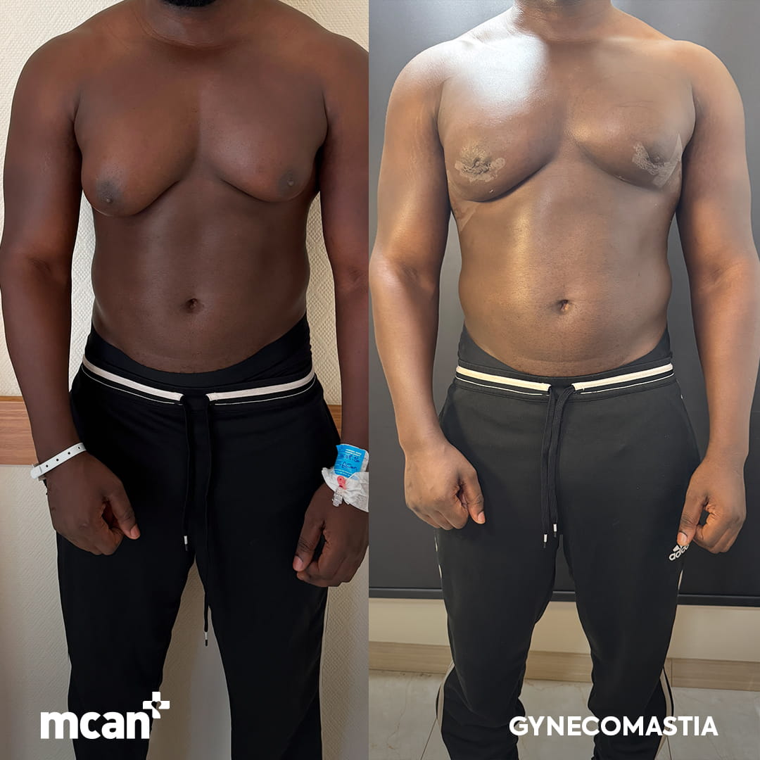 GYNECOMASTIA
