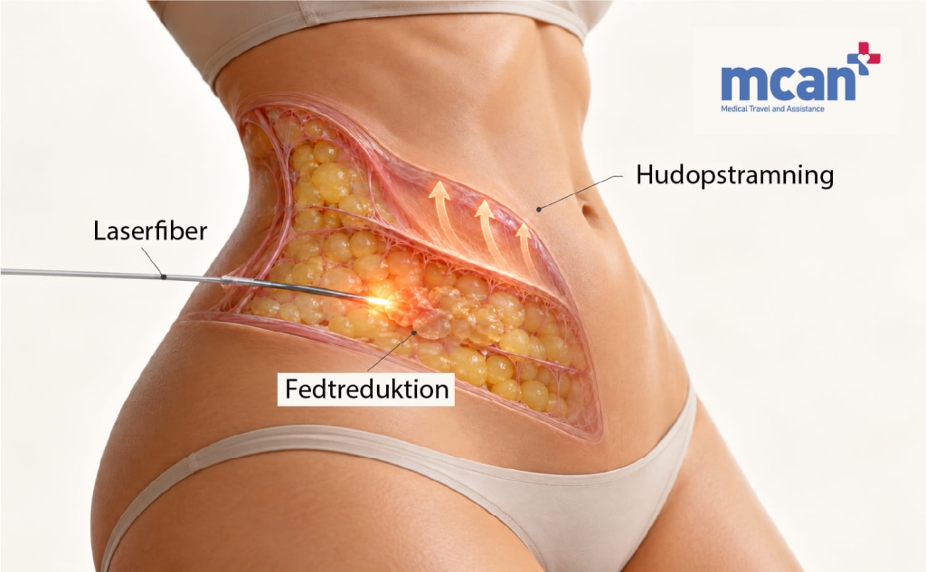 Endolift vs fedtsugning ved løs hud: sådan vælger du den rigtige løsning til din grad af hudslaphed 2 Heres what Endolift actually does to loose skin da Heres what Endolift actually does to loose skin da