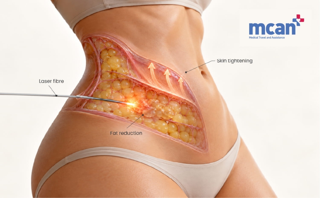 Endolift vs Liposuction for Loose Skin: How to Choose the Right Option for Your Laxity Level 2 Heres what Endolift actually does to loose skin en Heres what Endolift actually does to loose skin en