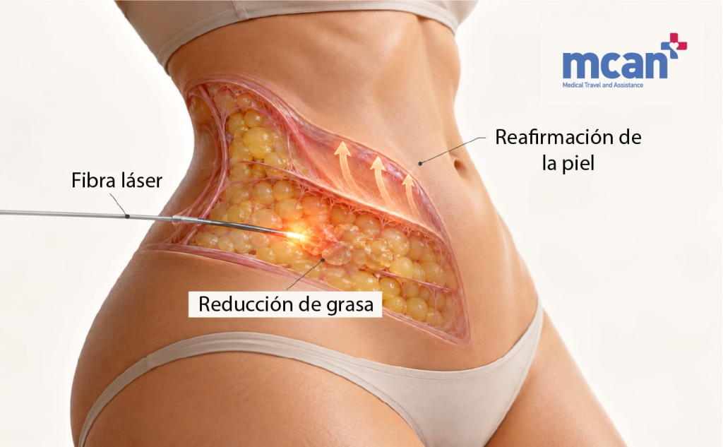 Endolift vs liposucción para la piel flácida: cómo elegir la opción adecuada según tu grado de flacidez 2 Heres what Endolift actually does to loose skin es Heres what Endolift actually does to loose skin es