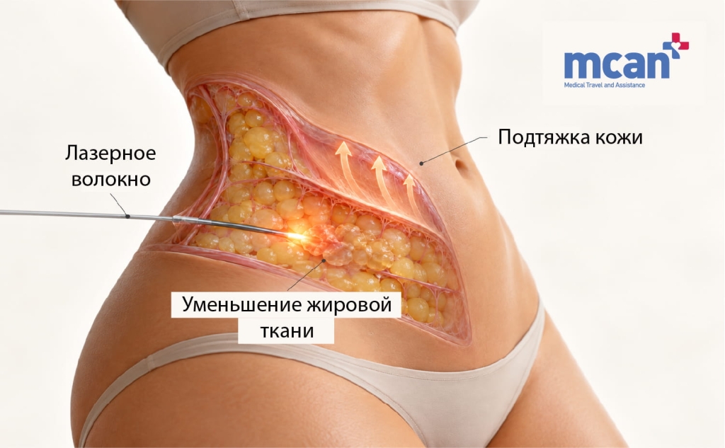 Эндолифт или липосакция при дряблой коже: как выбрать подходящий вариант для вашей степени дряблости 2 Heres what Endolift actually does to loose skin ru Heres what Endolift actually does to loose skin ru