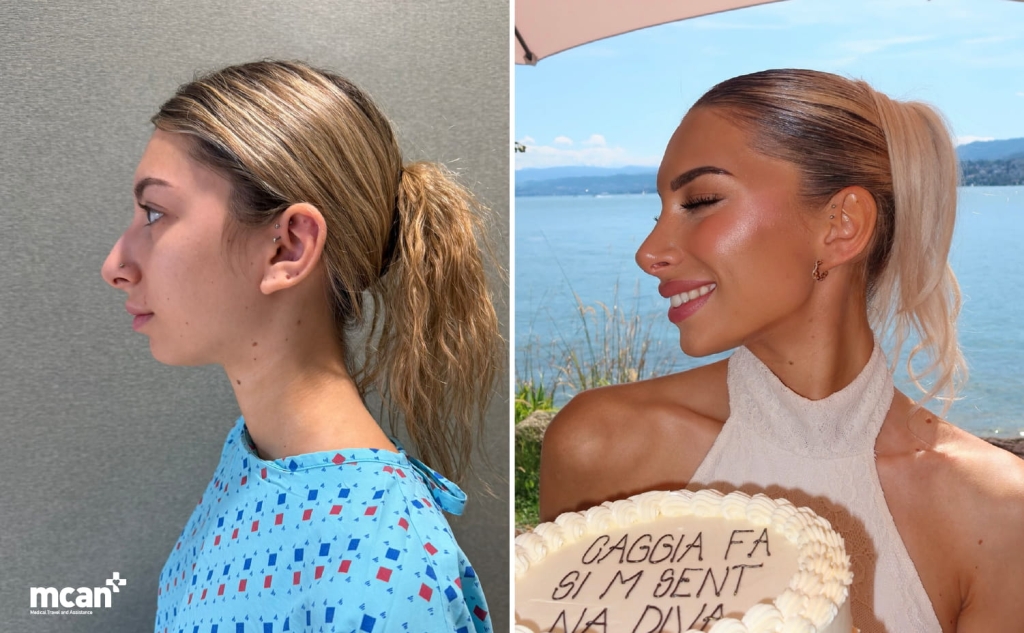 Natural looking rhinoplasty in Turkey with MCAN Health
