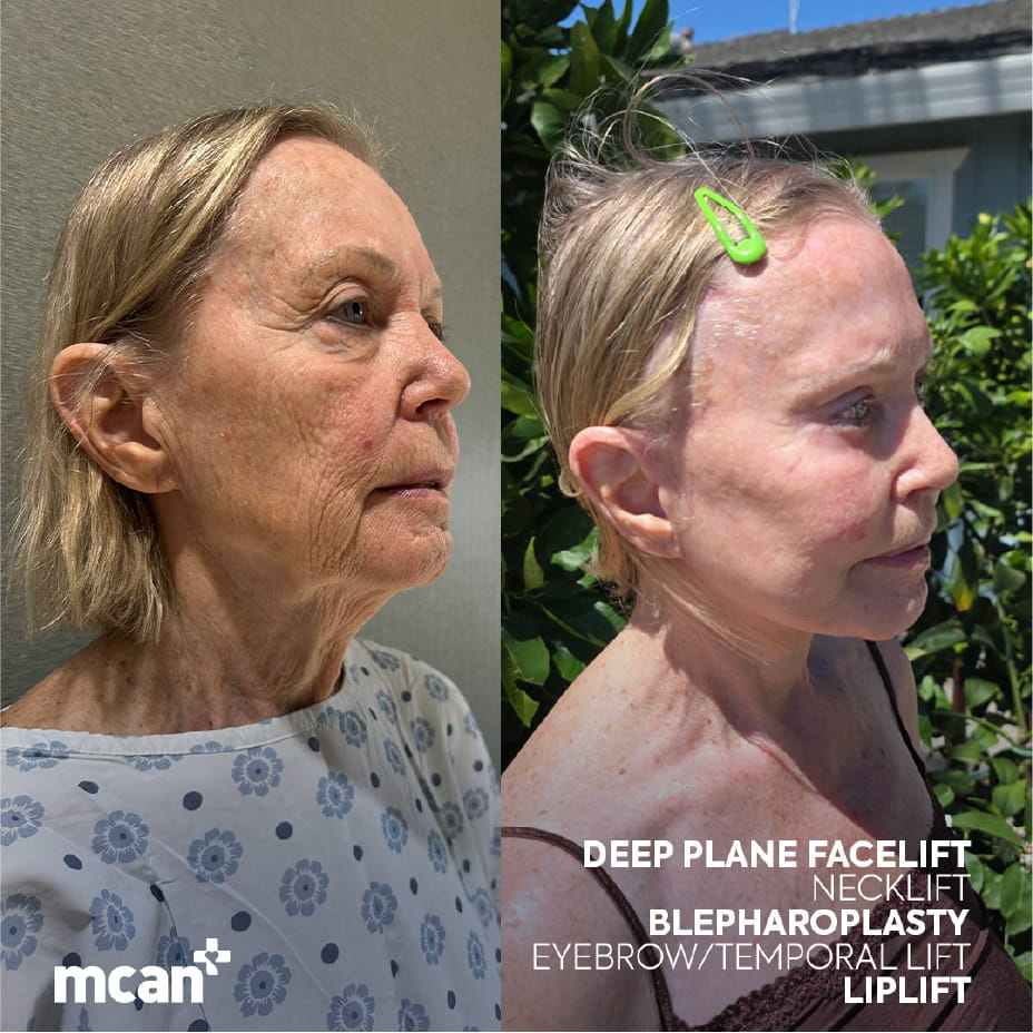 Neck Lift with Platysmaplasty at MCAN Health 1