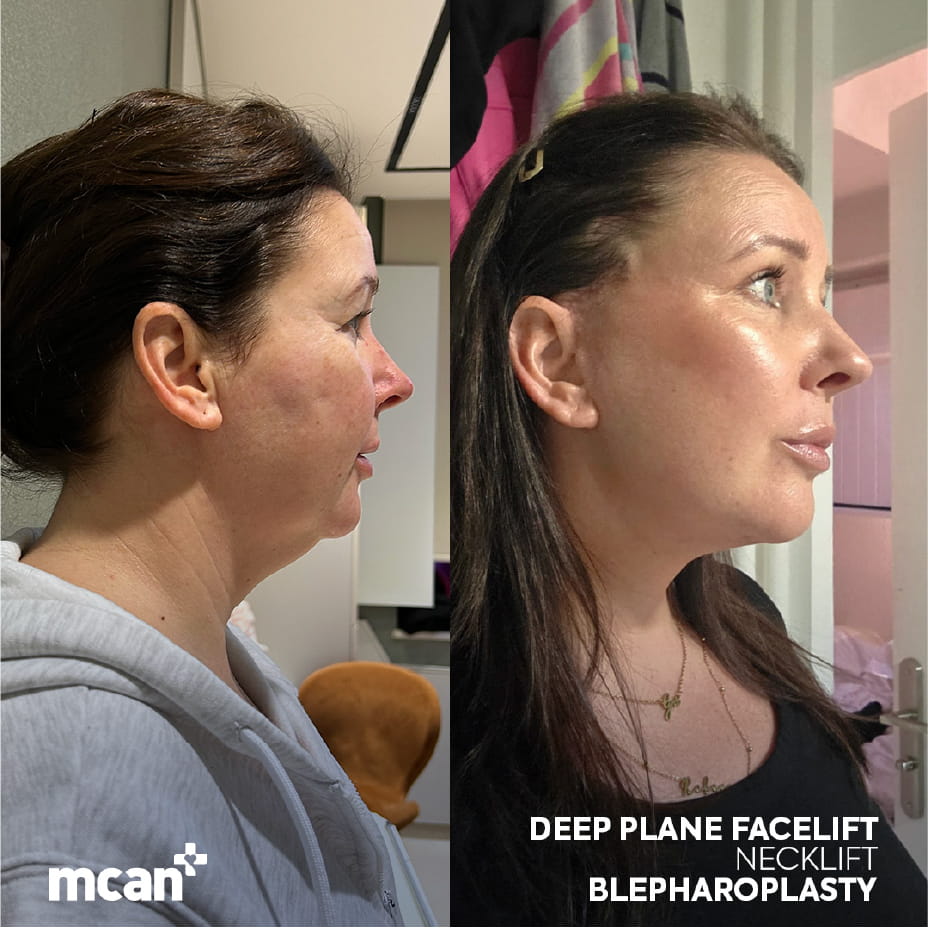 Neck Lift with Platysmaplasty at MCAN Health 2