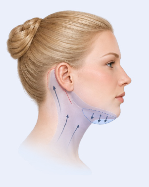 Neck lift with Chin liposuction