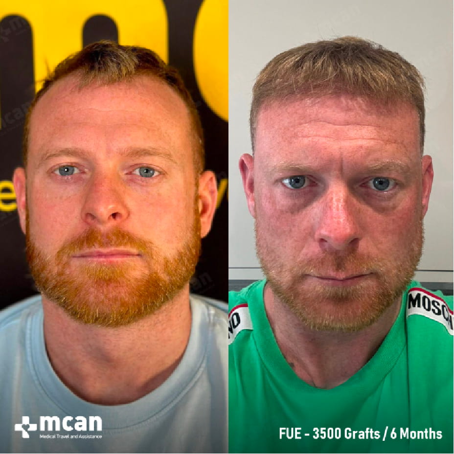 Spenderkapazitat, Deckung und Dichte: Das Dreieck der Haartransplantation erklart 5 Planning Your Hair Transplant Triangle with MCAN Health in Turkey Planning Your Hair Transplant Triangle with MCAN Health in Turkey