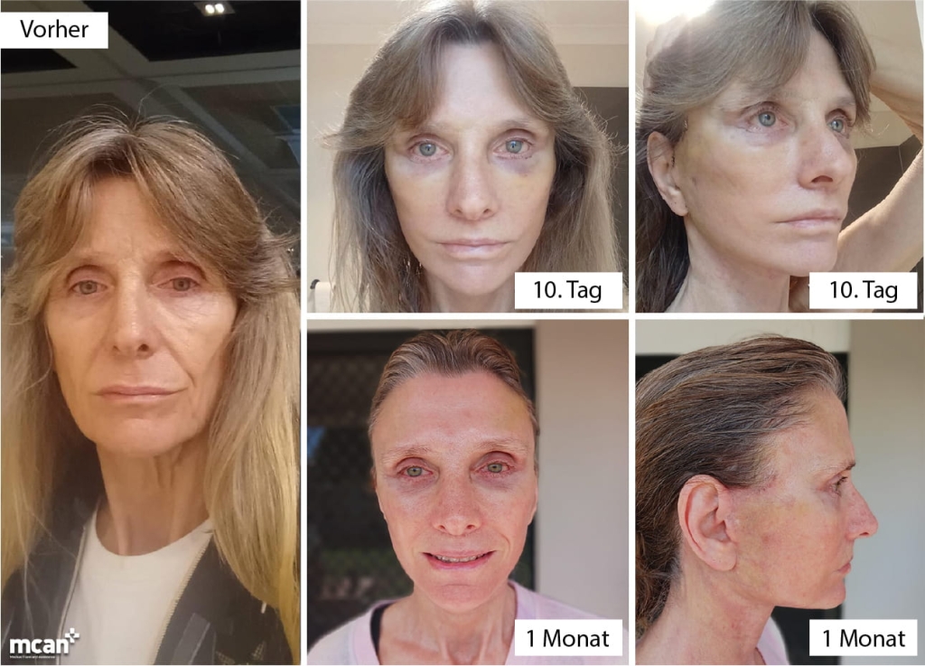 Eigenfetttransfer im Gesicht: Wie viel Fett wird entnommen und woher? 4 Recovery After a Combined Facelift and Fat Transfer de Recovery After a Combined Facelift and Fat Transfer de