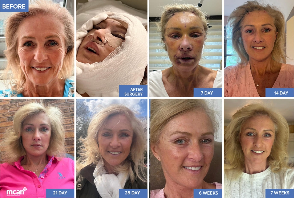 Recovery and How Long Results Last EN
