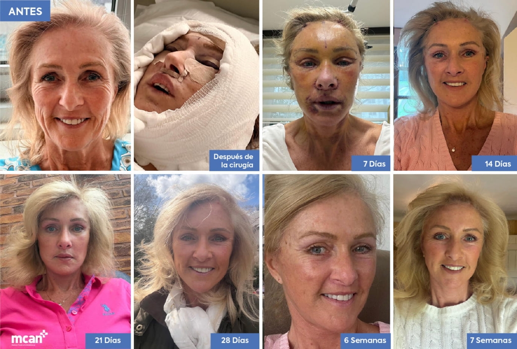 Blefaroplastia vs. Lifting de Cejas: ¿qué procedimiento corrige los ojos caídos y pesados? 4 Recovery and How Long Results Last ES 1 Recovery and How Long Results Last ES 1