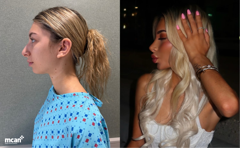 Dramatic vs Natural Rhinoplasty Results: How MCAN Health Keeps Noses Looking Like You 4 Rhinoplasty in Turkey with MCAN Health a nose that still looks like you Rhinoplasty in Turkey with MCAN Health a nose that still looks like you