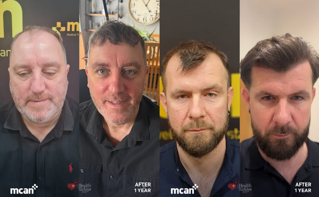 Second Hair Transplant in Turkey with MCAN Health