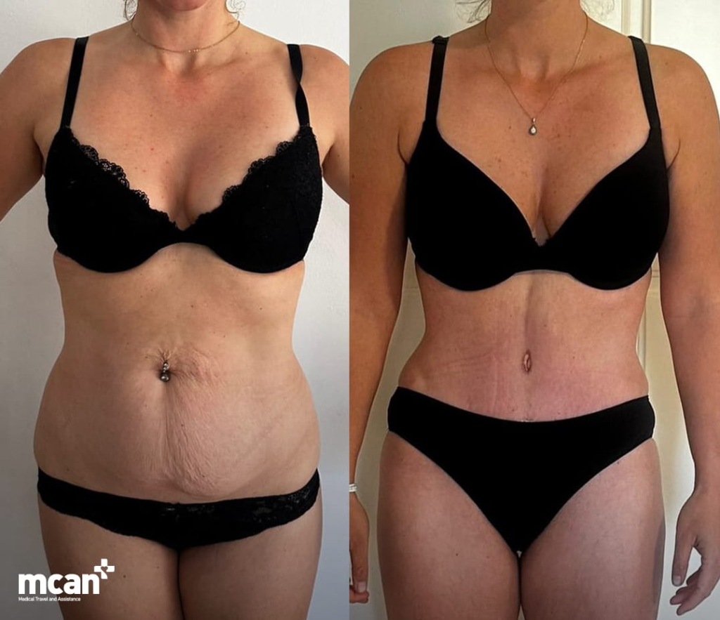 Endolift vs Liposuction for Loose Skin: How to Choose the Right Option for Your Laxity Level 3 Skin Laxity Endolift and Liposuction 1 Skin Laxity Endolift and Liposuction 1