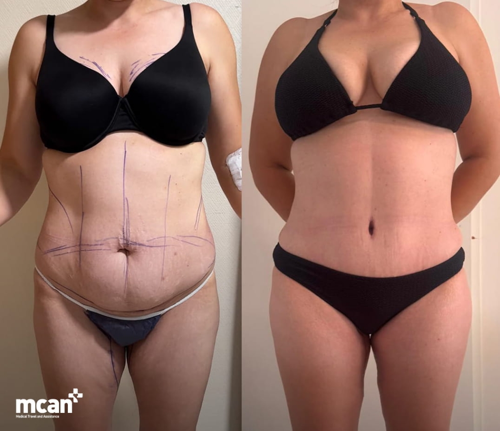 Endolift vs Liposuction for Loose Skin: How to Choose the Right Option for Your Laxity Level 4 Skin Laxity Endolift and Liposuction 2 Skin Laxity Endolift and Liposuction 2