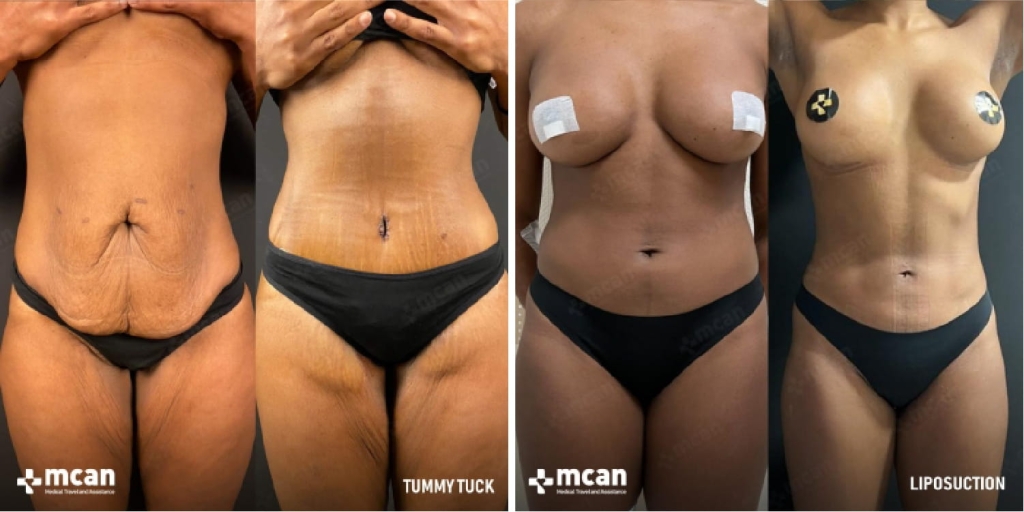 Lipo Vaser vs Abdominoplastie : quelle intervention aplatit durablement le bas du ventre ? 5 VASER Lipo and Tummy Tuck in Turkey with MCAN Health 2 VASER Lipo and Tummy Tuck in Turkey with MCAN Health 2