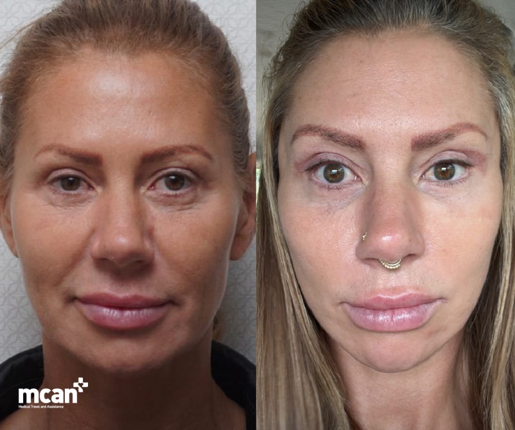 What Is Blepharoplasty 1