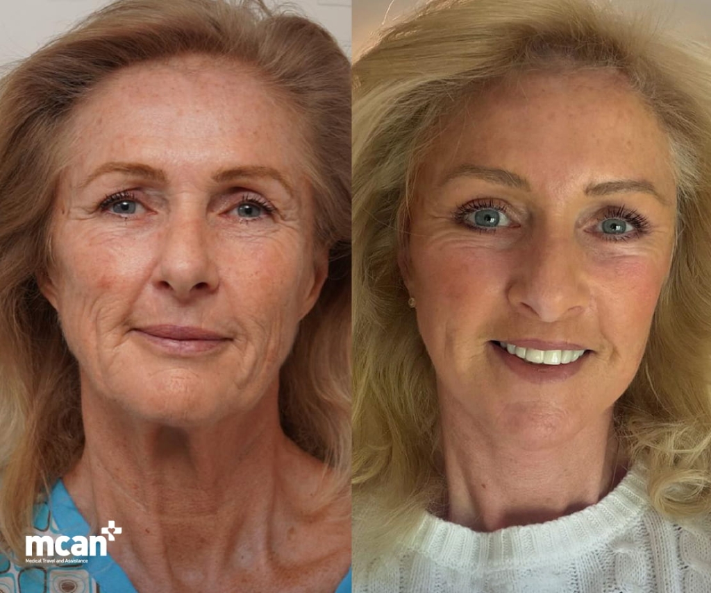 Lidstraffung vs. Stirnlift: Welcher Eingriff hilft bei hängenden, schweren Augen? 3 What Is a Brow Lift 1 What Is a Brow Lift 1