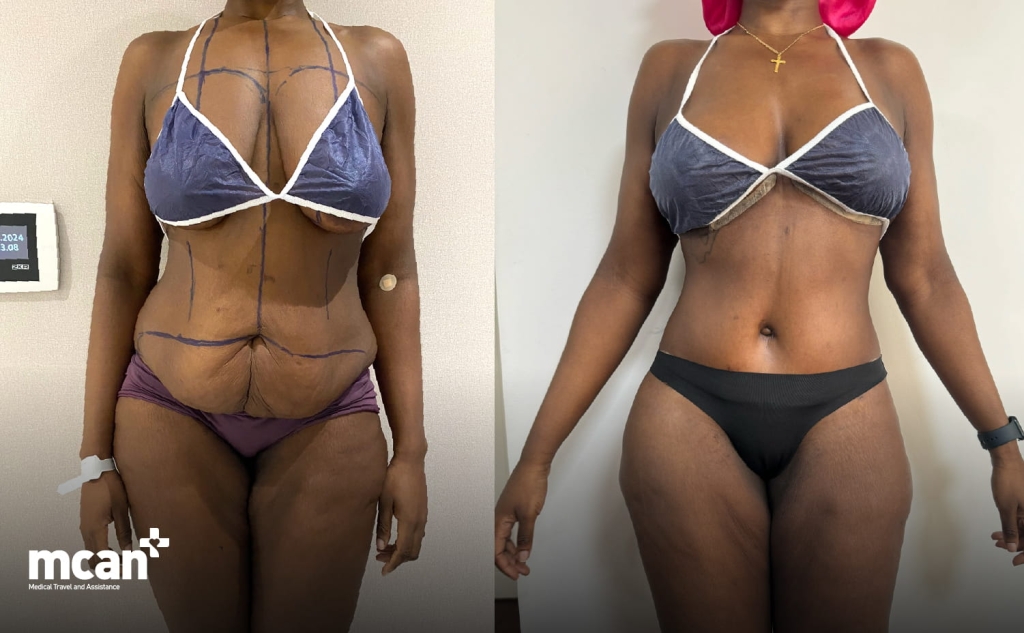 VASER Lipo vs. Tummy Tuck: Which Flattens Your Lower Belly Permanently? 3 What Is a Tummy Tuck Abdominoplasty What Is a Tummy Tuck Abdominoplasty