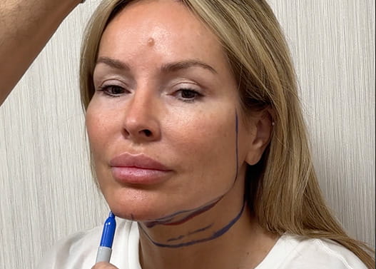 What is a Neck Lift 2