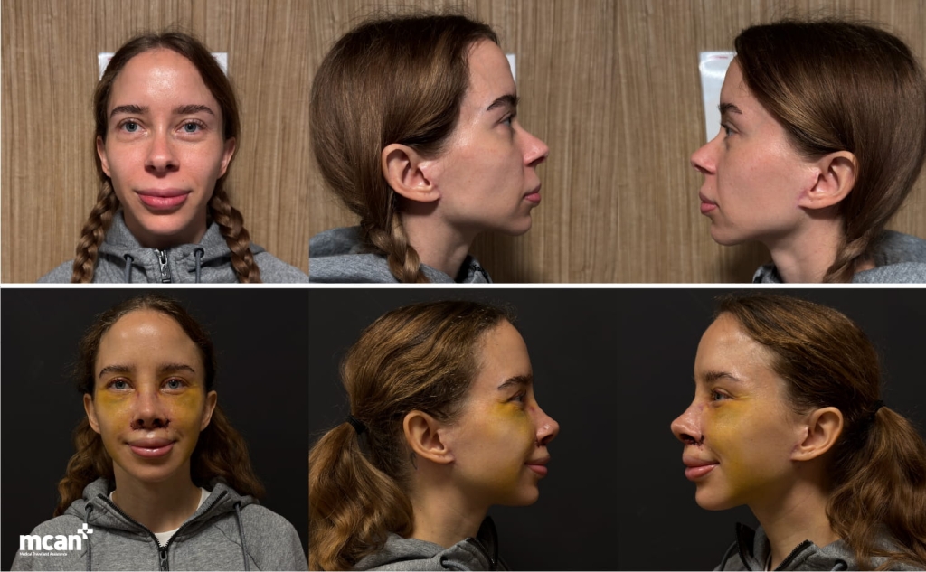 Dramatic vs Natural Rhinoplasty Results: How MCAN Health Keeps Noses Looking Like You 3 When is a revision or touch up safer than a second dramatic surgery When is a revision or touch up safer than a second dramatic surgery