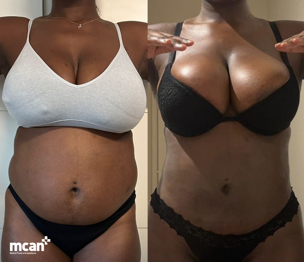 Endolift vs Liposuction for Loose Skin: How to Choose the Right Option for Your Laxity Level 5 When is surgery in Turkey with MCAN Health the safer choice 1 When is surgery in Turkey with MCAN Health the safer choice 1