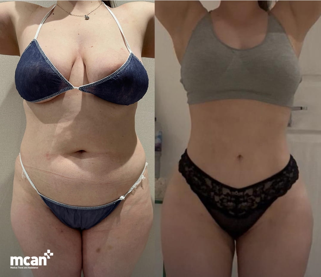 Endolift vs Liposuction for Loose Skin: How to Choose the Right Option for Your Laxity Level 6 When is surgery in Turkey with MCAN Health the safer choice 2 When is surgery in Turkey with MCAN Health the safer choice 2
