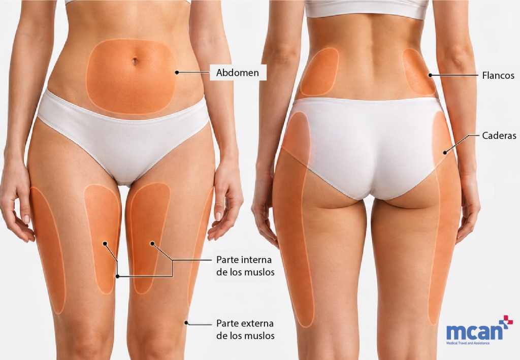 Injerto de grasa facial: cuánta grasa se extrae y de dónde 3 Where the Fat Comes From es Where the Fat Comes From es