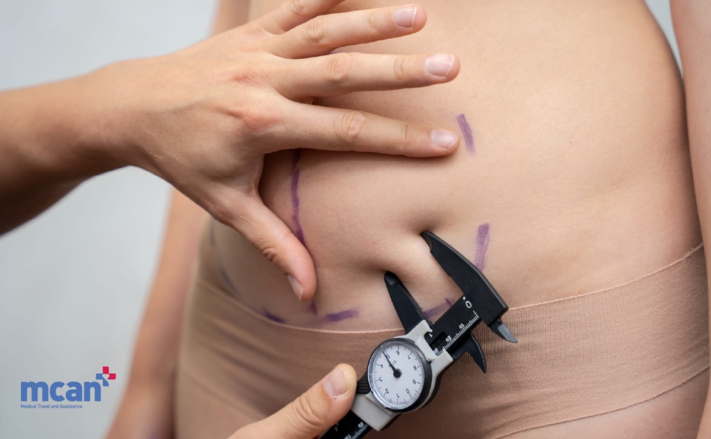 VASER Lipo vs. Tummy Tuck: Which Flattens Your Lower Belly Permanently? 4 Which One Actually Flattens the Lower Belly Which One Actually Flattens the Lower Belly