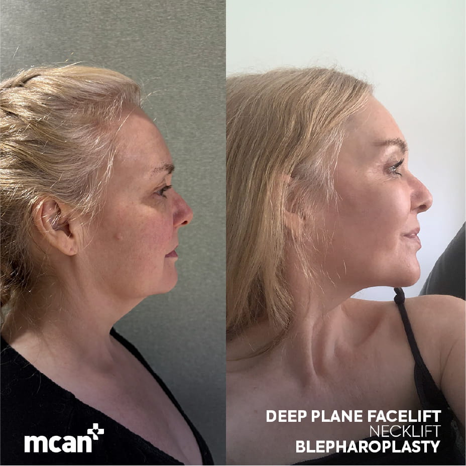 Who Is a Good Candidate and When Is a Facelift Added 1