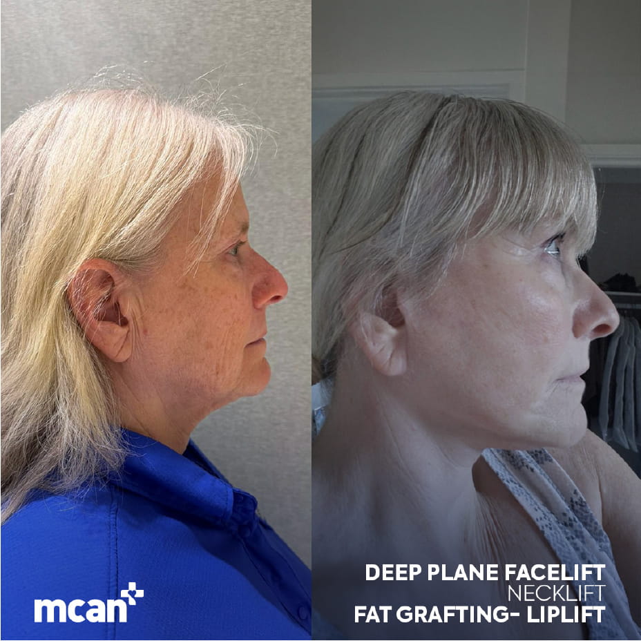 Who Is a Good Candidate and When Is a Facelift Added 2