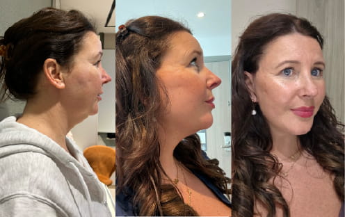 Why Should You Get a Neck Lift in Turkey
