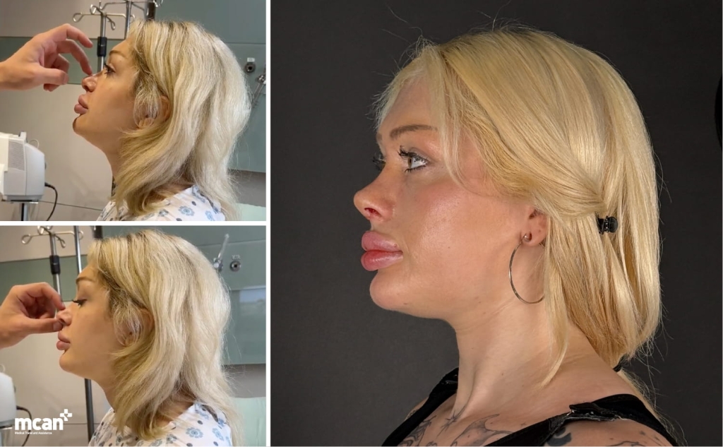 Dramatic vs Natural Rhinoplasty Results: How MCAN Health Keeps Noses Looking Like You 2 Why do some clinics deliver more natural results than others Why do some clinics deliver more natural results than others