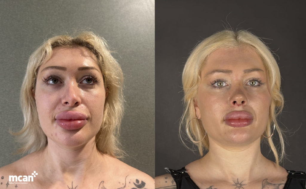 Why is Turkey a serious option for a subtle nose job 1