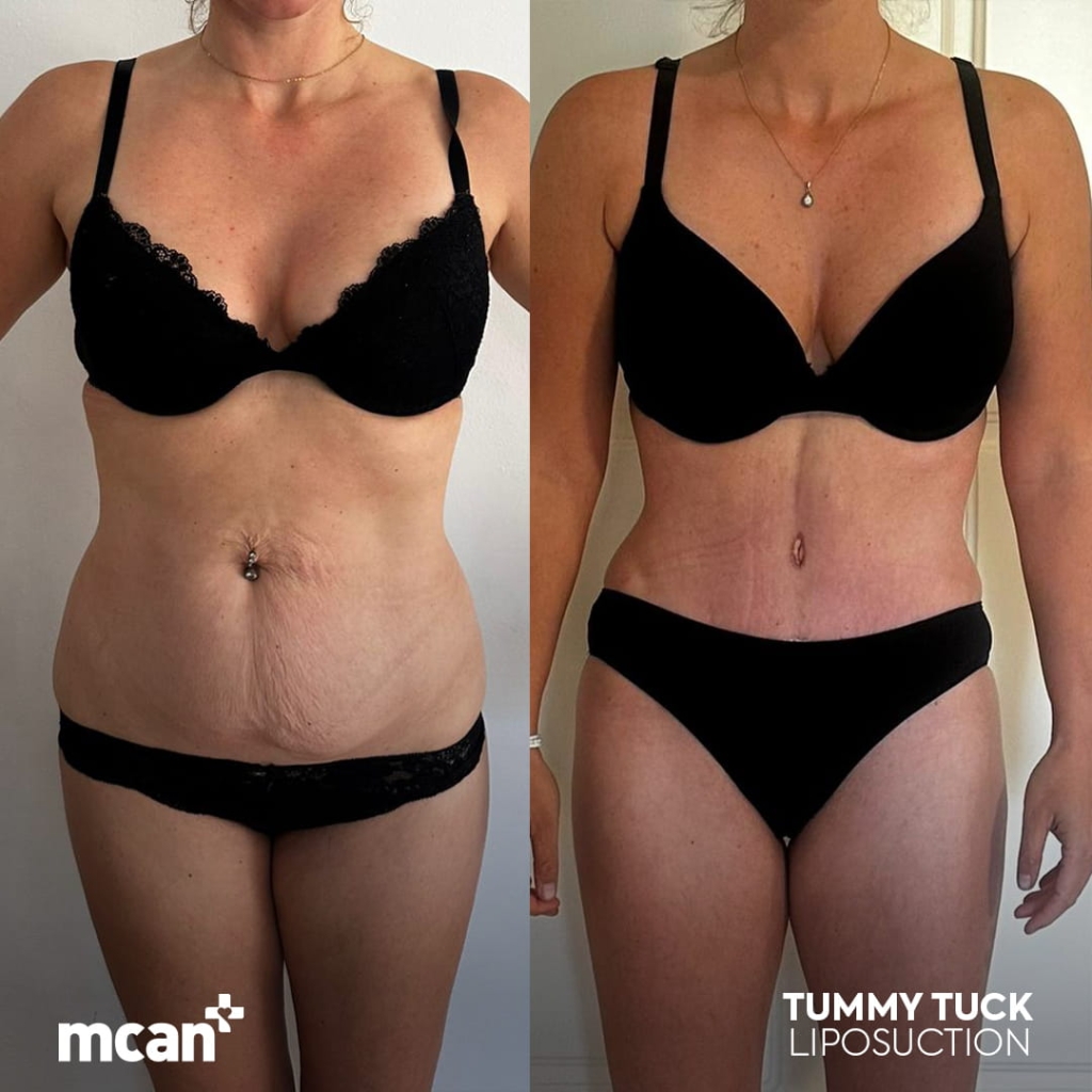 Safe and Effective Tummy Tuck Abroad: Turkey & UK Patient Safety Checklist 5 angelina ferrera 1 angelina ferrera 1