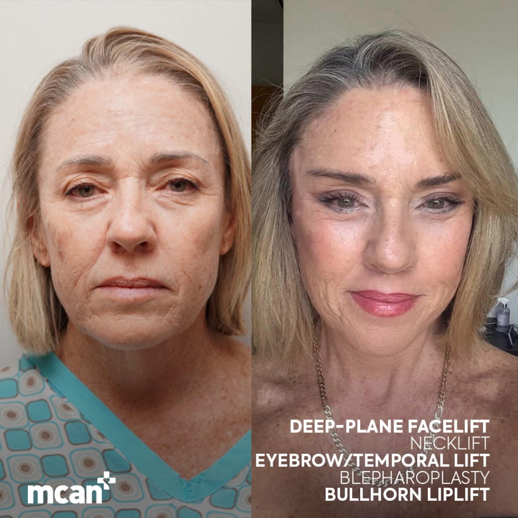 Facelift in Turkey 7 chandra hickox chandra hickox