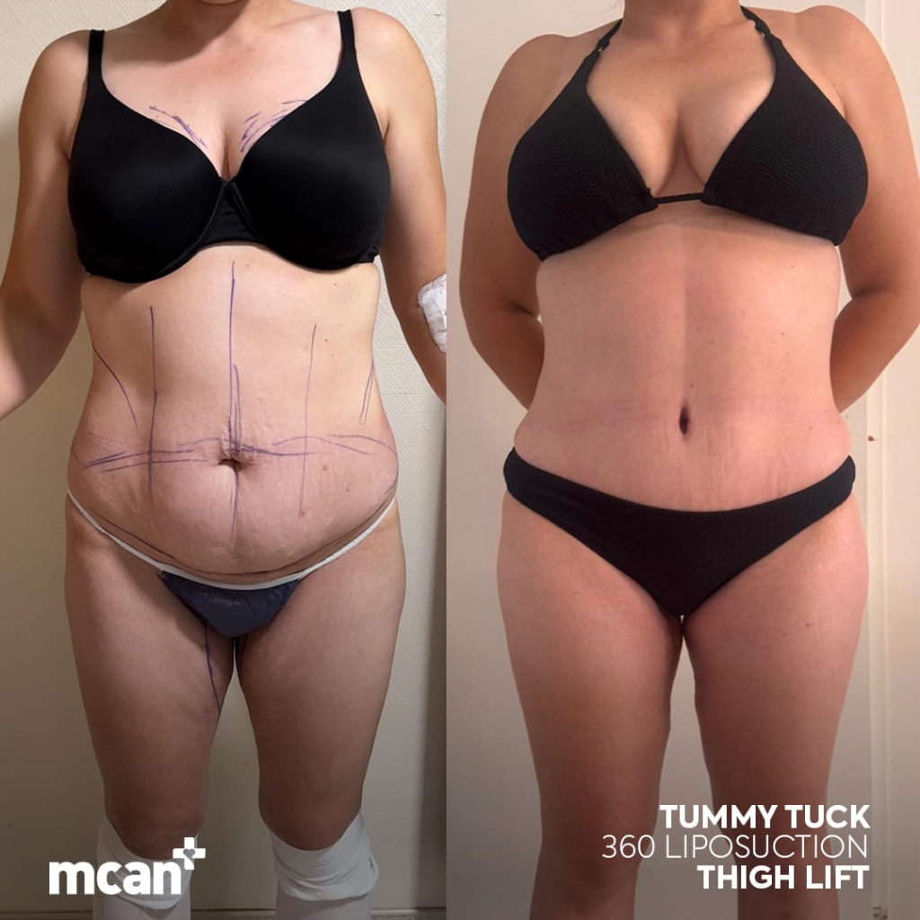 Tummy Tuck in Turkey 5 chantel love chantel love