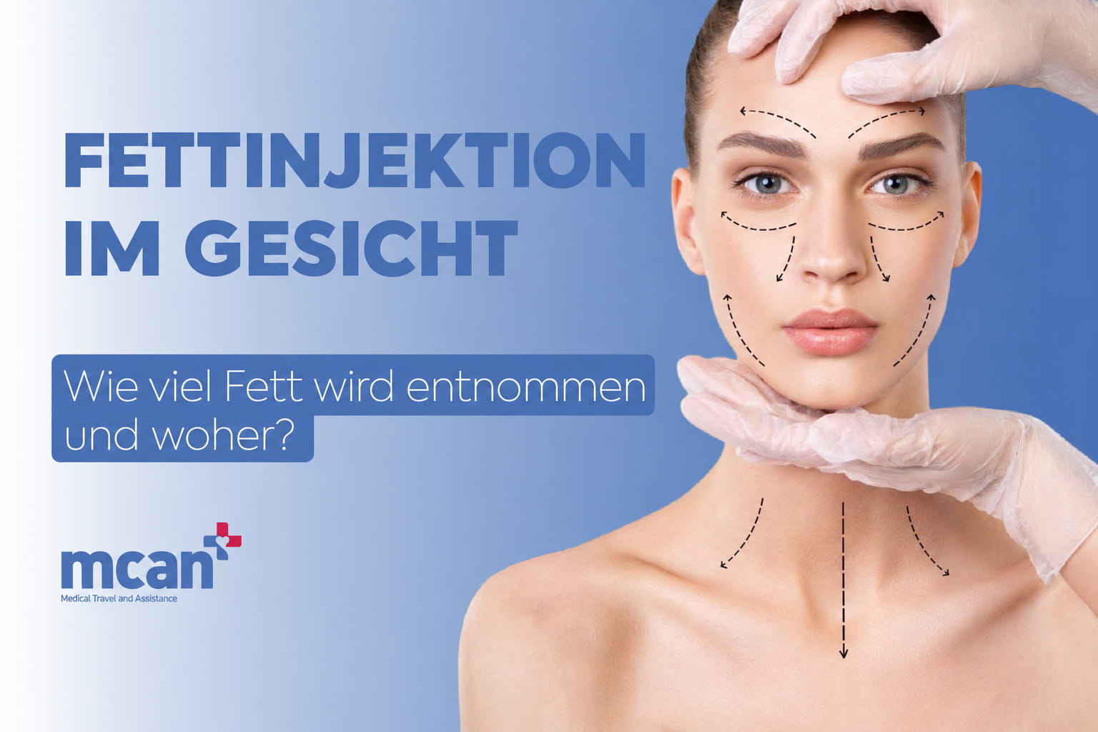 Eigenfetttransfer im Gesicht: Wie viel Fett wird entnommen und woher? 1 fettinjektion im gesicht deutsch 1 fettinjektion im gesicht deutsch 1