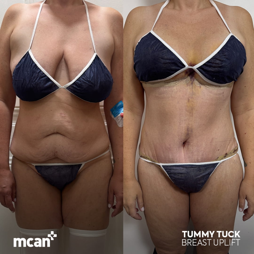 Tummy Tuck in Turkey 7 helene vogt helene vogt