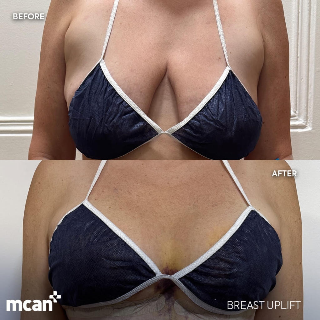 Breast Lift in Turkey 4 helene vogt 2 helene vogt 2