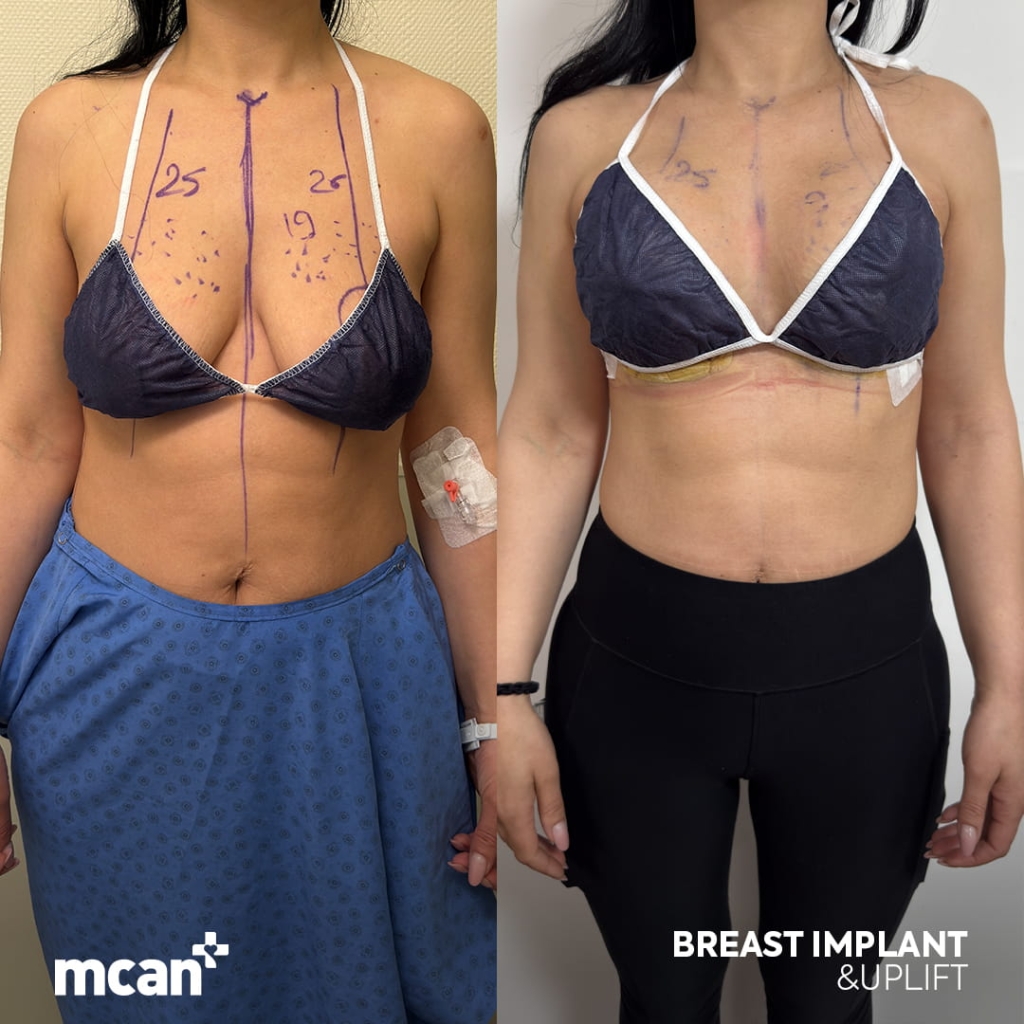 Breast Lift in Turkey 5 ludmila papusa ludmila papusa