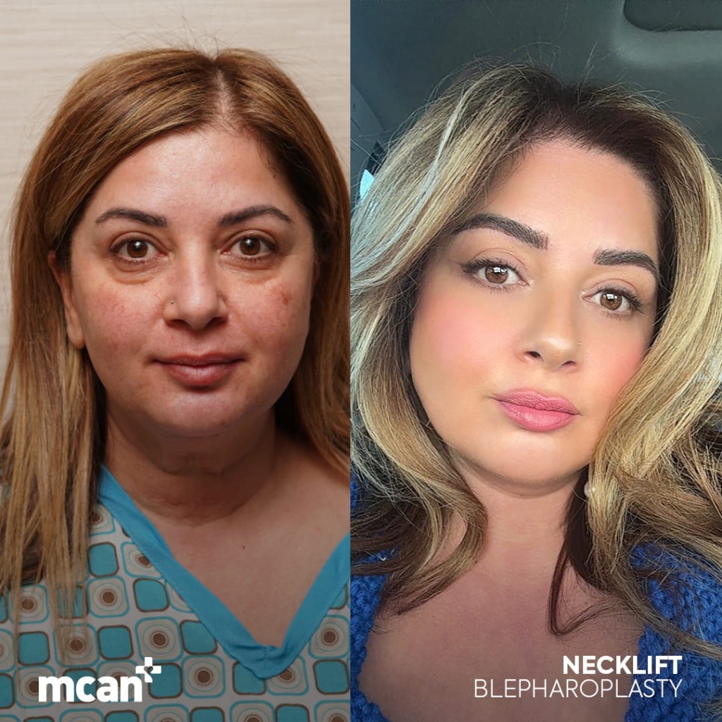 Facelift in Turkey 5 remonda remonda