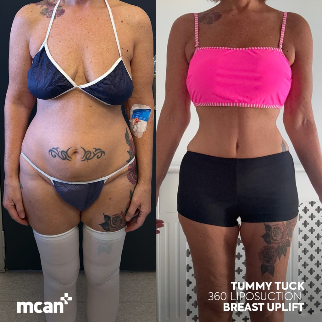 Safe and Effective Tummy Tuck Abroad: Turkey & UK Patient Safety Checklist 4 sally anne 1 sally anne 1