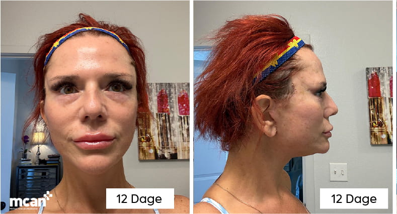 What Does Neck Lift Recovery Look Like Week by Week DA copy 2