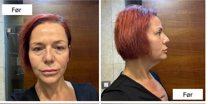 What Does Neck Lift Recovery Look Like Week by Week DA