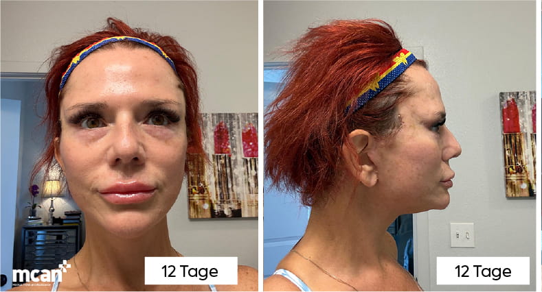 Halslift mit Platysmaplastik: Wie Chirurgen den „Truthahnhals“ beseitigen 7 What Does Neck Lift Recovery Look Like Week by Week DE copy 2 What Does Neck Lift Recovery Look Like Week by Week DE copy 2
