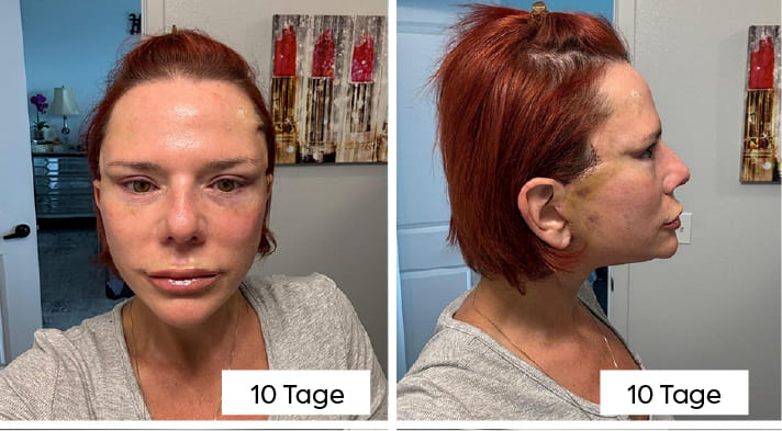 Halslift mit Platysmaplastik: Wie Chirurgen den „Truthahnhals“ beseitigen 6 What Does Neck Lift Recovery Look Like Week by Week DE copy What Does Neck Lift Recovery Look Like Week by Week DE copy